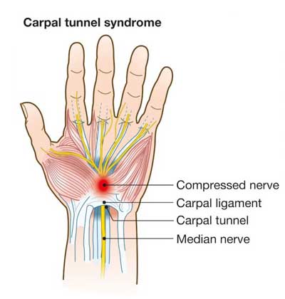 Carpal tunnel syndrome