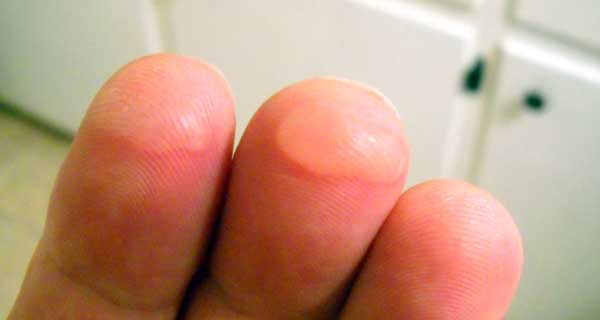 Guitar fingers blister